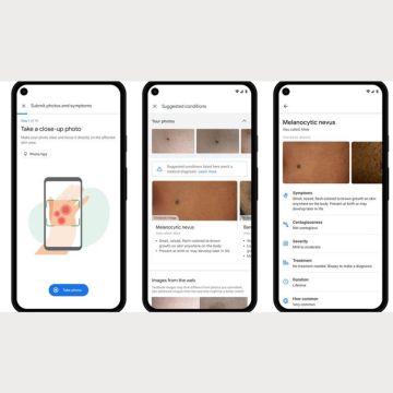 Εφαρμογή της Google με χρήση τεχνητής νοημοσύνης θέλει να γίνει ο δερματολόγος σας